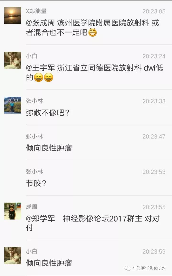 【病例】右侧小脑星形细胞瘤II级1例MR