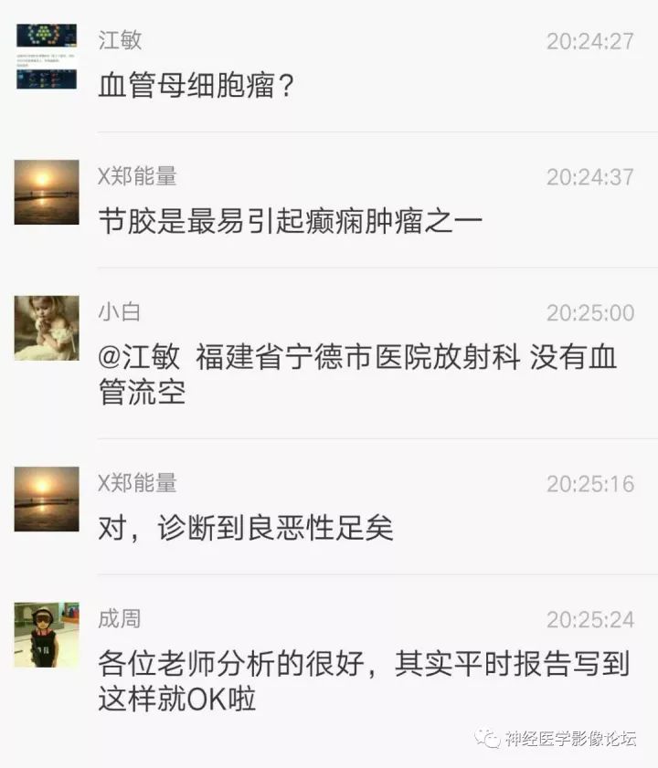 【病例】右侧小脑星形细胞瘤II级1例MR