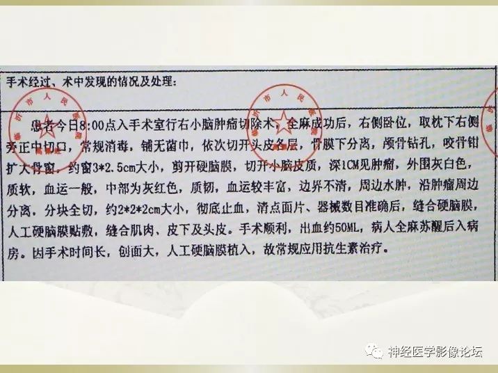【病例】右侧小脑星形细胞瘤II级1例MR