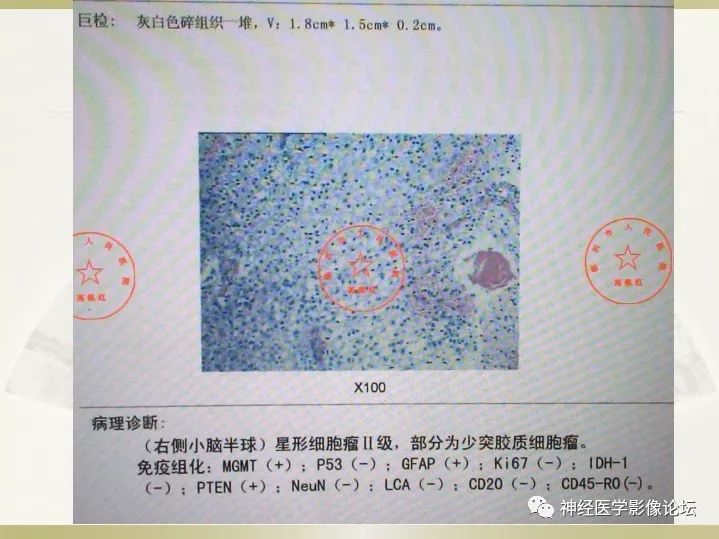 【病例】右侧小脑星形细胞瘤II级1例MR