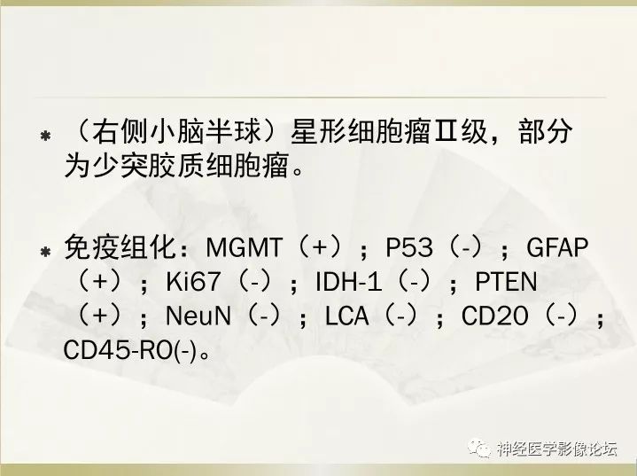 【病例】右侧小脑星形细胞瘤II级1例MR