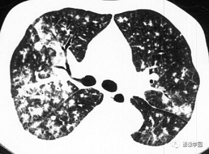 HRCT影像：周边支气管血管型结节之AIDS病合并KS