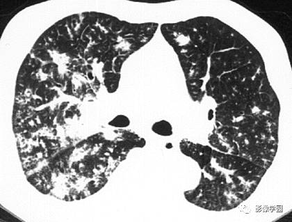 HRCT影像:周边支气管血管型结节之AIDS病合并KS HRCT影像:周边支气管血管型结节之AIDS病合并KS