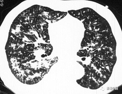 HRCT影像:周边支气管血管型结节之AIDS病合并KS HRCT影像:周边支气管血管型结节之AIDS病合并KS