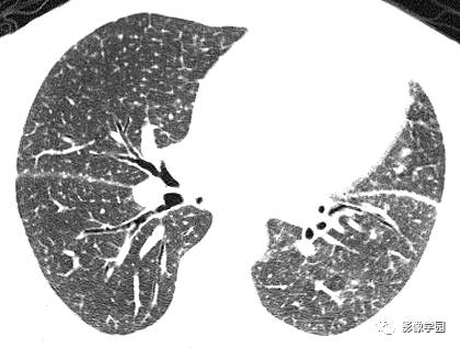 HRCT影像:周边支气管血管型结节之AIDS病合并KS HRCT影像:周边支气管血管型结节之AIDS病合并KS