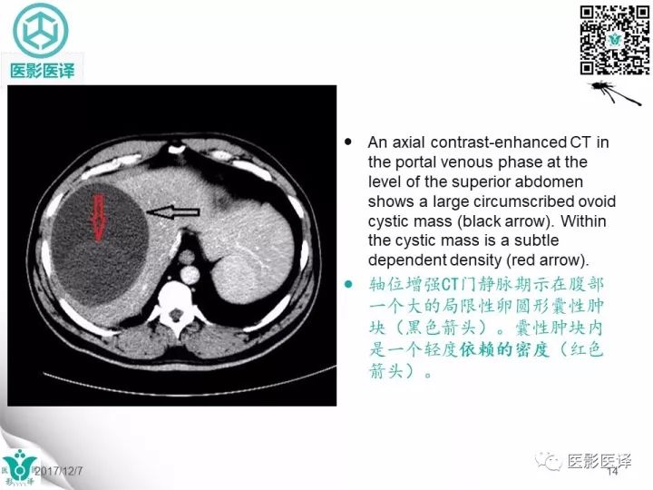 【病例】肝包虫囊肿1例CT及MR