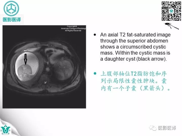 【病例】肝包虫囊肿1例CT及MR