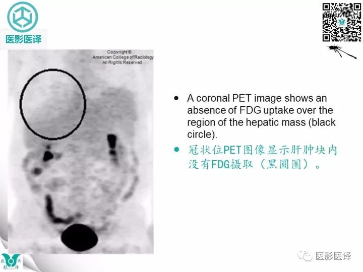 【病例】肝包虫囊肿1例CT及MR