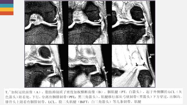 【PPT】膝关节外侧副韧带及外侧支持带解剖及损伤MR诊断