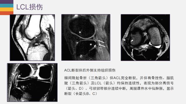 【PPT】膝关节外侧副韧带及外侧支持带解剖及损伤MR诊断