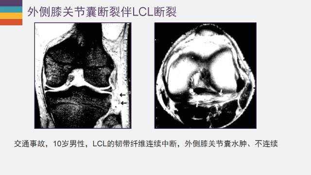 【PPT】膝关节外侧副韧带及外侧支持带解剖及损伤MR诊断