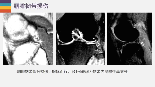 【PPT】膝关节外侧副韧带及外侧支持带解剖及损伤MR诊断