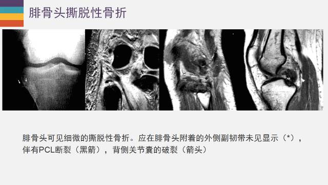 【PPT】膝关节外侧副韧带及外侧支持带解剖及损伤MR诊断