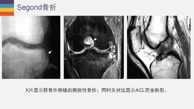 【PPT】膝关节外侧副韧带及外侧支持带解剖及损伤MR诊断