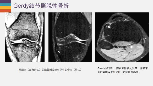 【PPT】膝关节外侧副韧带及外侧支持带解剖及损伤MR诊断