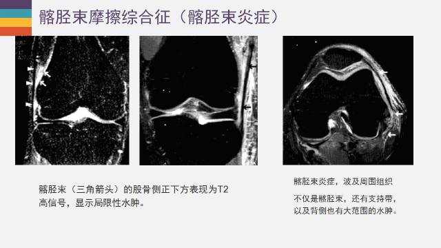 【PPT】膝关节外侧副韧带及外侧支持带解剖及损伤MR诊断