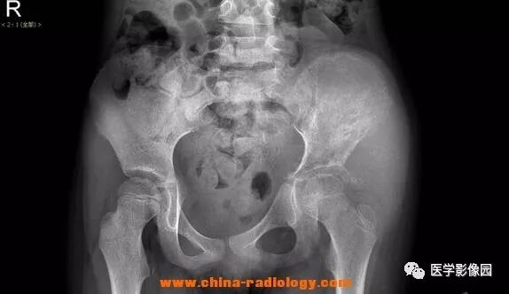 【病例】左髂骨尤文氏肉瘤1例CT影像表现 【病例】左髂骨尤文氏肉瘤1例CT影像表现