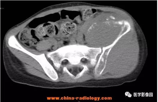 【病例】左髂骨尤文氏肉瘤1例CT影像表现 【病例】左髂骨尤文氏肉瘤1例CT影像表现
