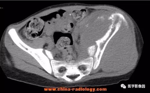【病例】左髂骨尤文氏肉瘤1例CT影像表现 【病例】左髂骨尤文氏肉瘤1例CT影像表现