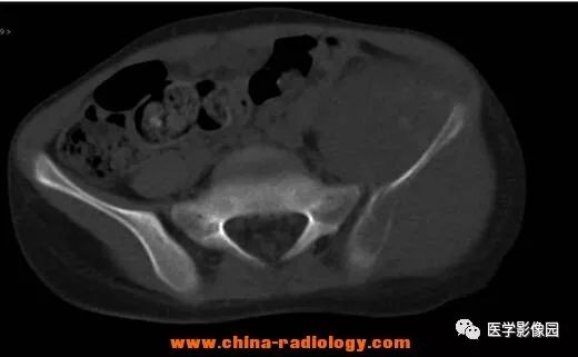 【病例】左髂骨尤文氏肉瘤1例CT影像表现 【病例】左髂骨尤文氏肉瘤1例CT影像表现