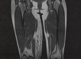 【病例】右大腿脂肪瘤1例MR影像表现