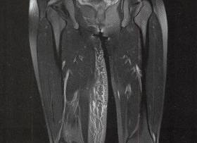 【病例】右大腿脂肪瘤1例MR影像表现
