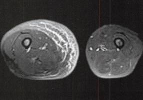 【病例】右大腿脂肪瘤1例MR影像表现