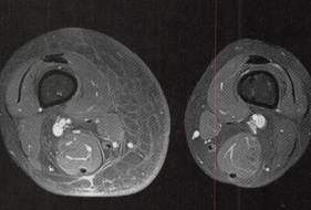 【病例】右大腿脂肪瘤1例MR影像表现