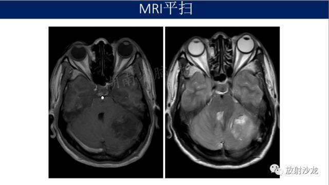 【病例】小脑表皮样囊肿1例MR影像表现