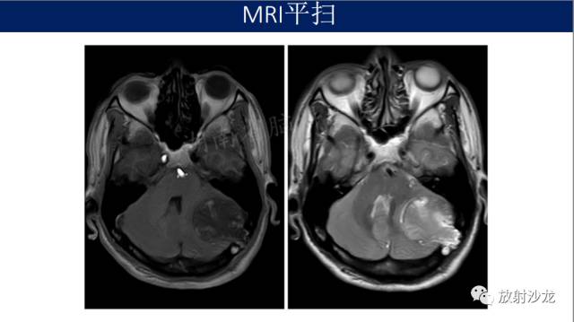 【病例】小脑表皮样囊肿1例MR影像表现