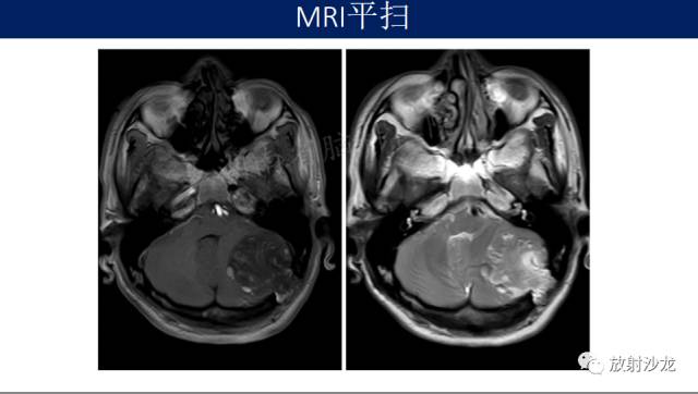 【病例】小脑表皮样囊肿1例MR影像表现