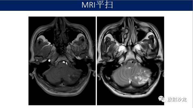 【病例】小脑表皮样囊肿1例MR影像表现