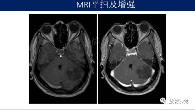 【病例】小脑表皮样囊肿1例MR影像表现