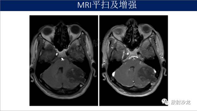 【病例】小脑表皮样囊肿1例MR影像表现