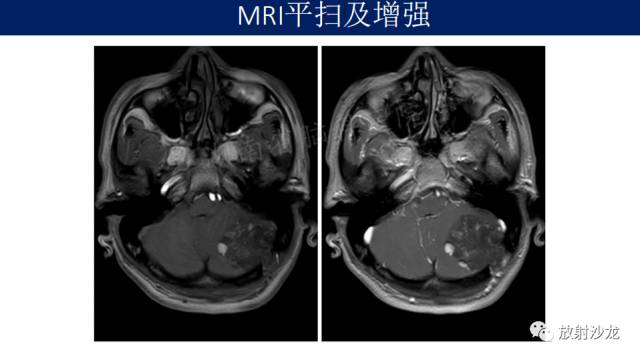 【病例】小脑表皮样囊肿1例MR影像表现