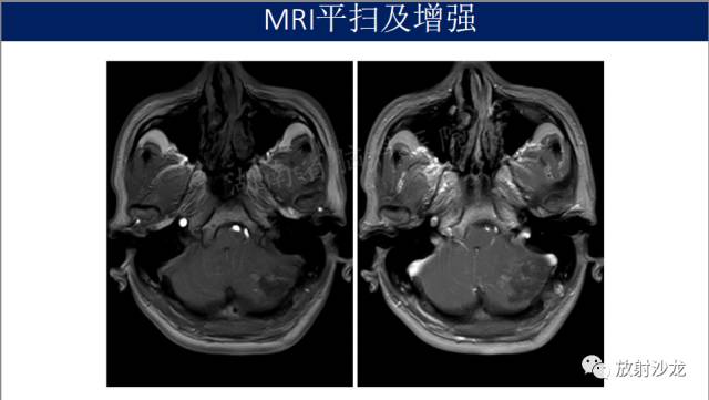 【病例】小脑表皮样囊肿1例MR影像表现