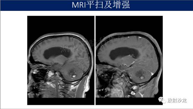 【病例】小脑表皮样囊肿1例MR影像表现