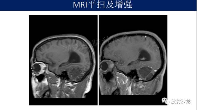 【病例】小脑表皮样囊肿1例MR影像表现