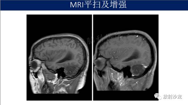 【病例】小脑表皮样囊肿1例MR影像表现