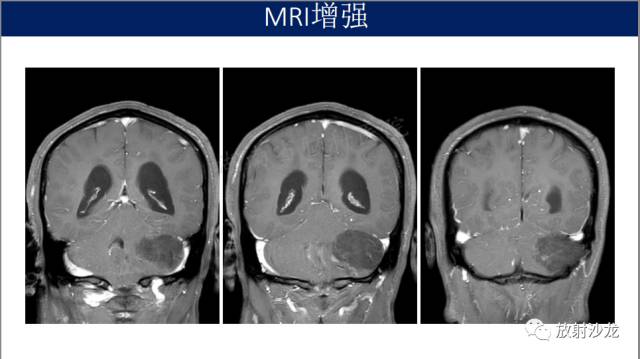【病例】小脑表皮样囊肿1例MR影像表现