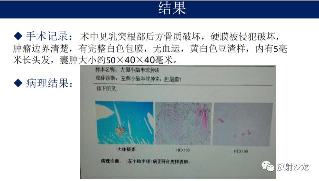 【病例】小脑表皮样囊肿1例MR影像表现