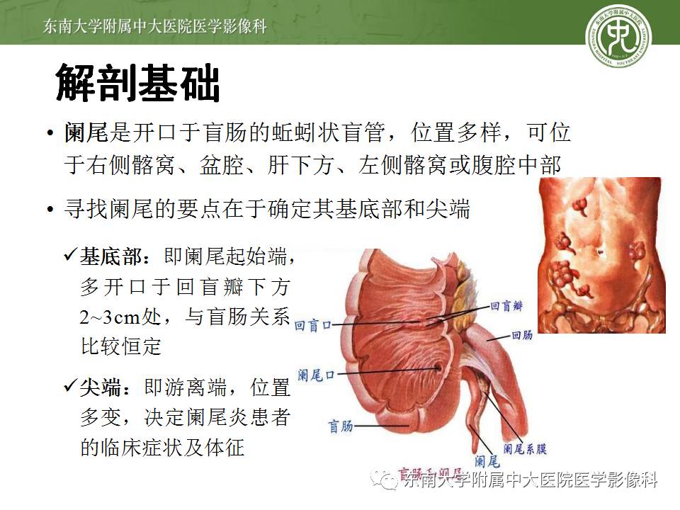 【病例】阑尾炎1例CT影像表现