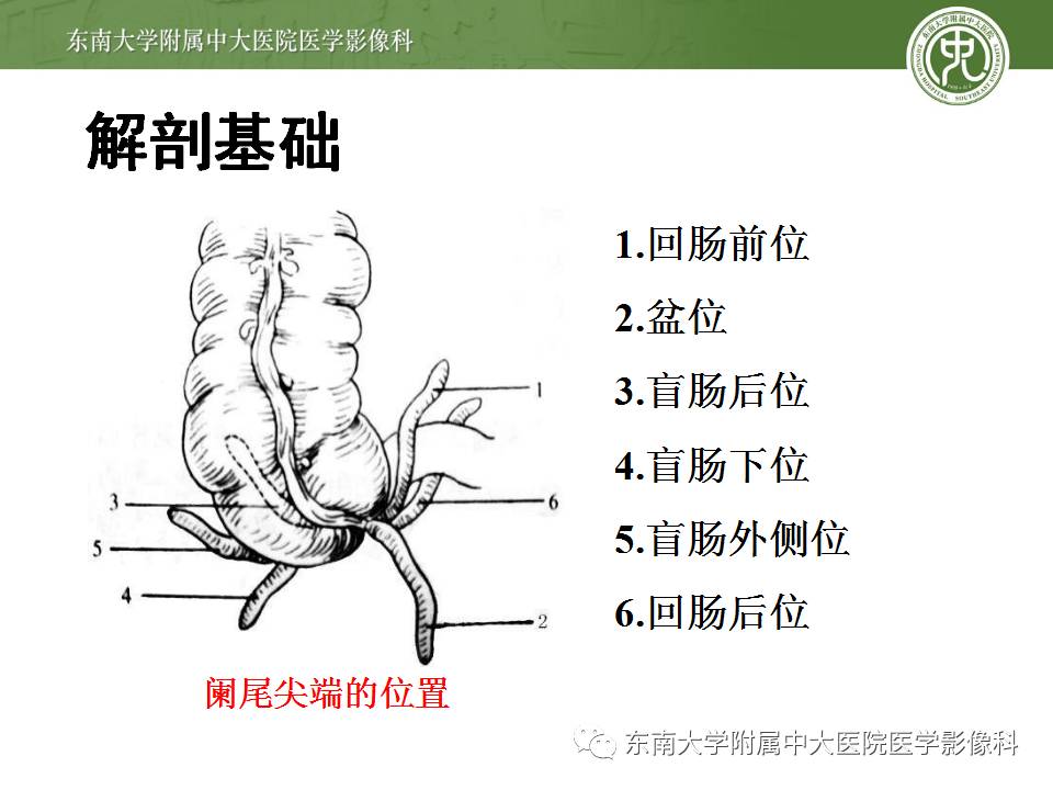 【病例】阑尾炎1例CT影像表现
