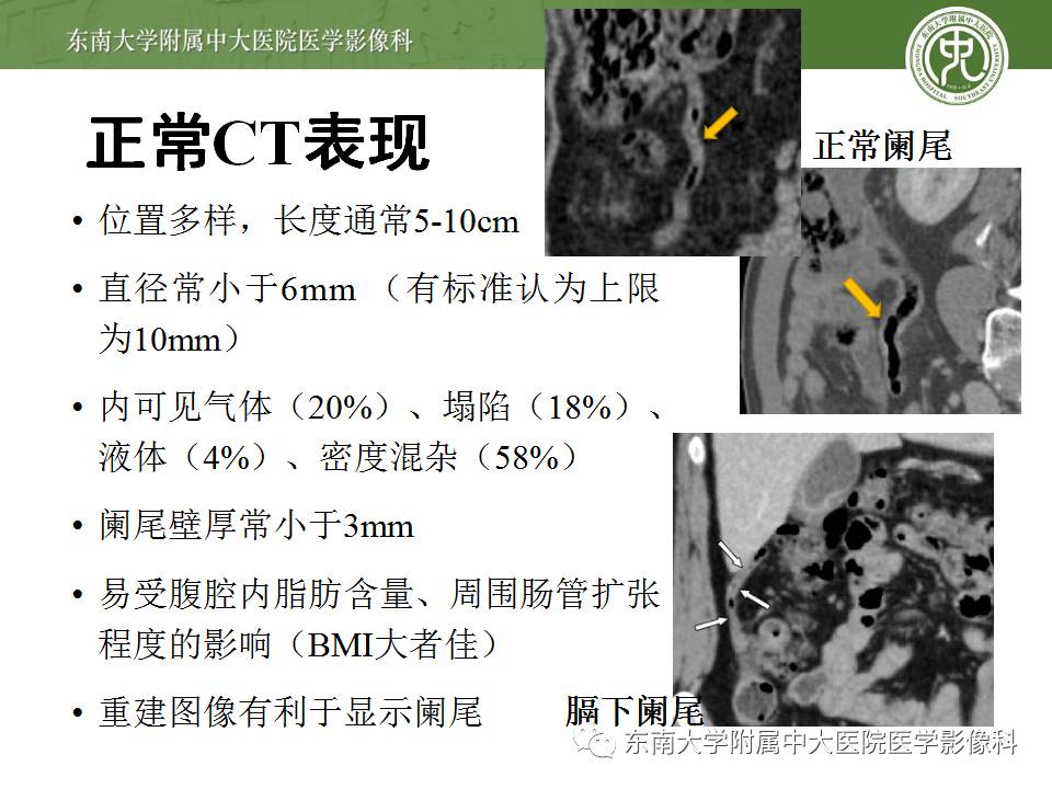 【病例】阑尾炎1例CT影像表现