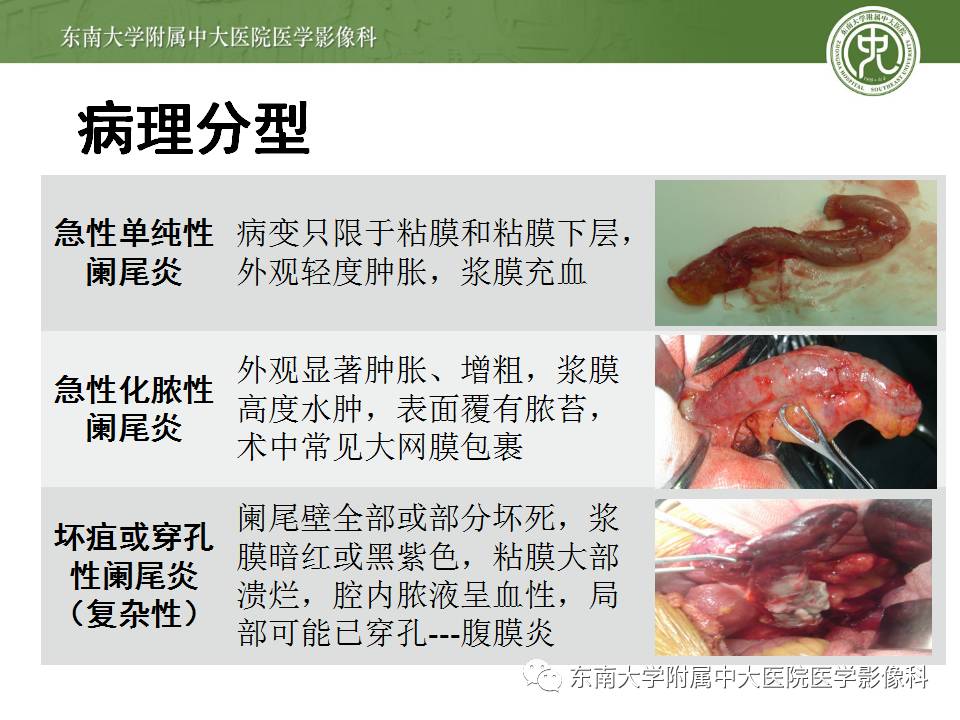 【病例】阑尾炎1例CT影像表现