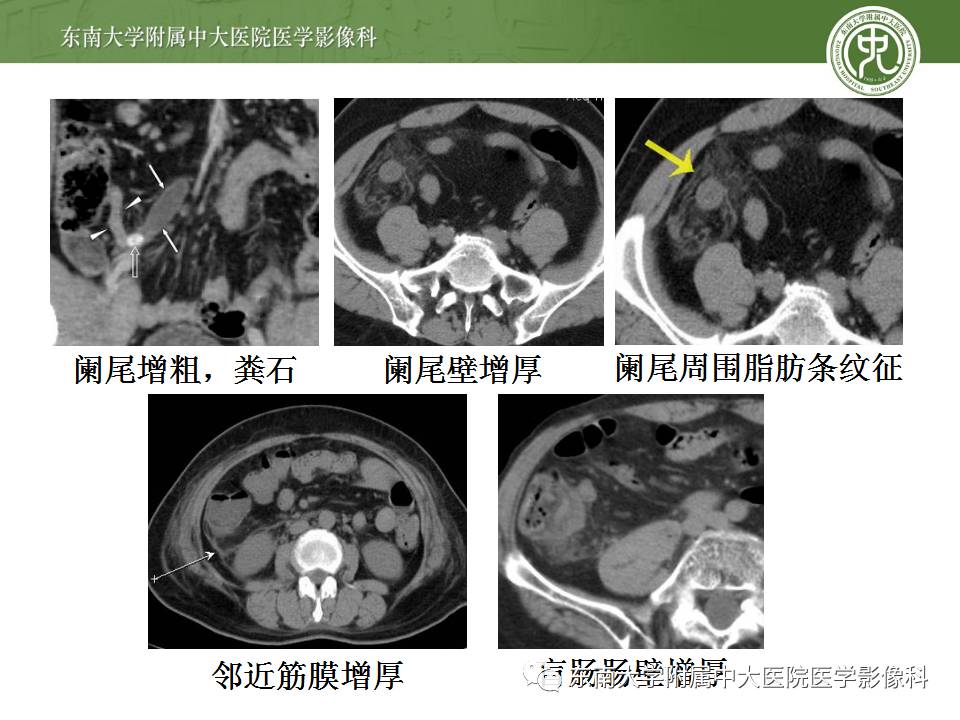 【病例】阑尾炎1例CT影像表现