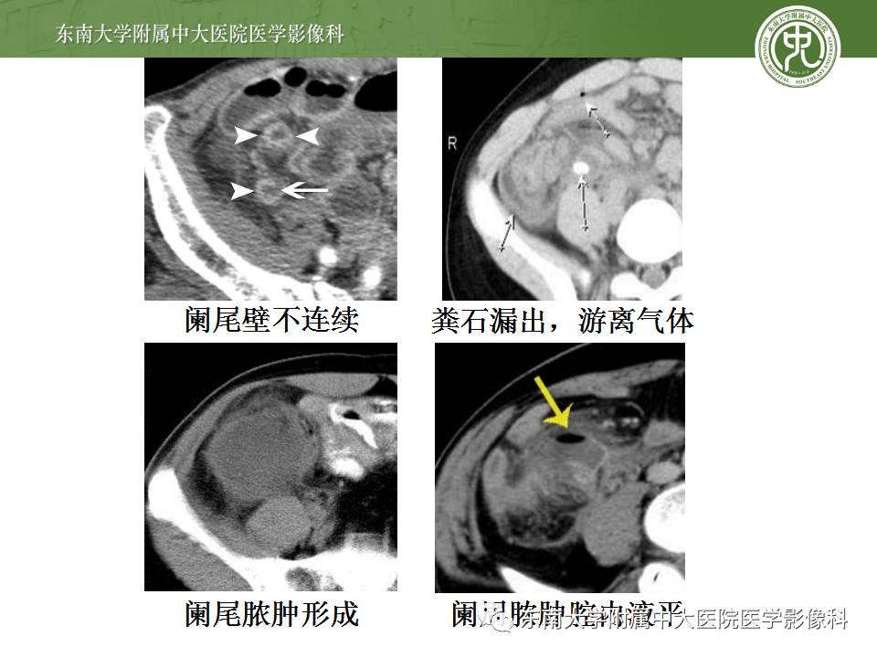 【病例】阑尾炎1例CT影像表现