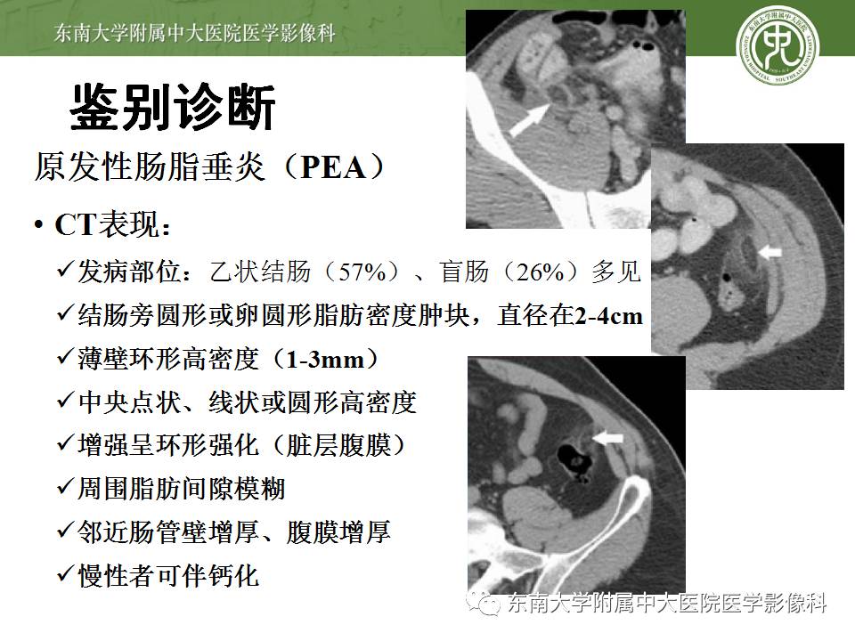 【病例】阑尾炎1例CT影像表现
