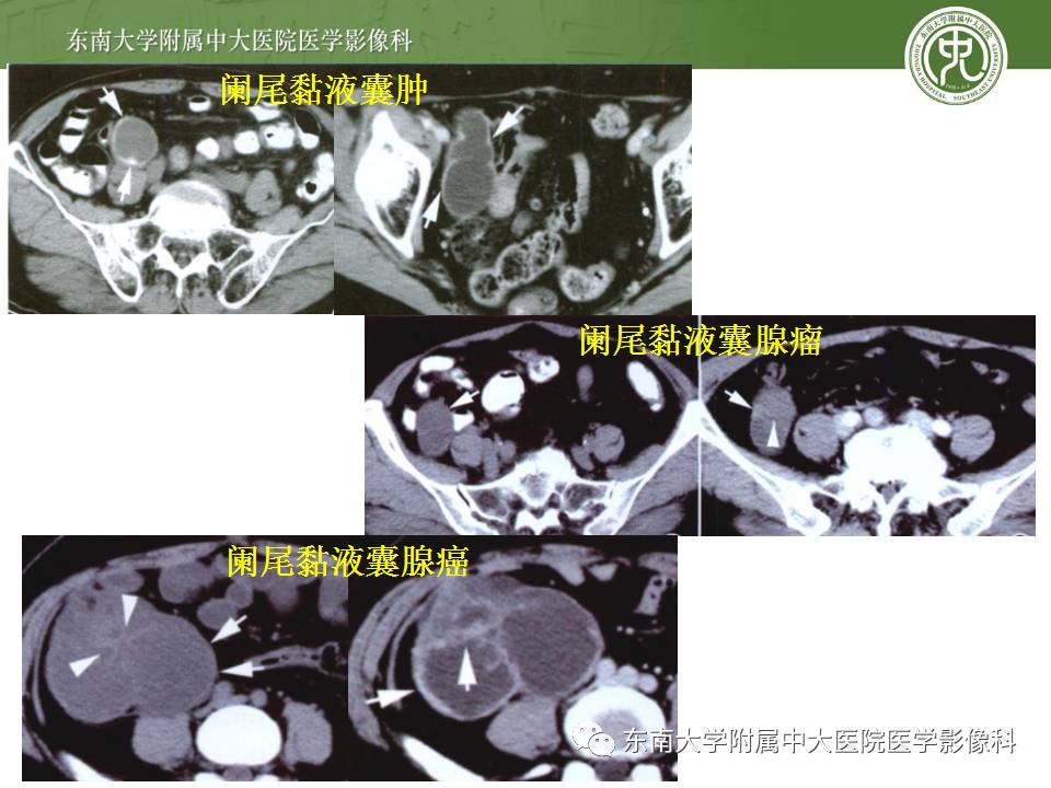 【病例】阑尾炎1例CT影像表现