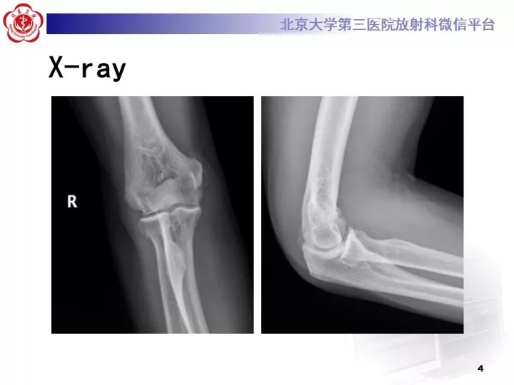 【病例】肘管综合征1例MR影像表现